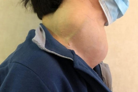 Bari, donna di 65anni salvata da tumore tiroide