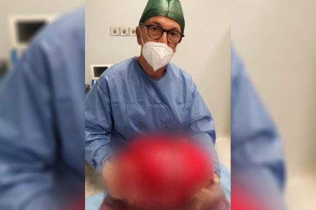 Bari, rimozione tumore di 20 chili